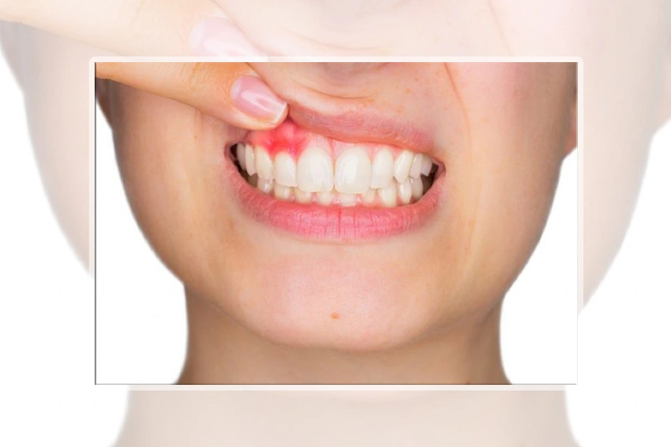 Viêm quanh cuống răng là gì? Dấu hiệu và biện pháp điều trị